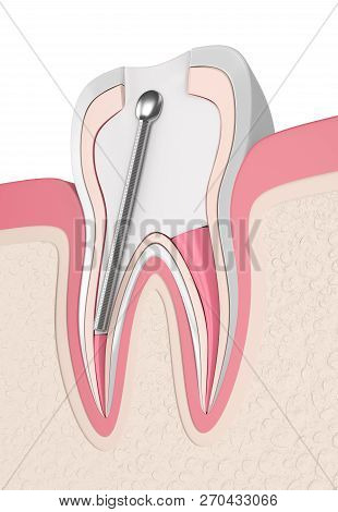 3d Render Of Tooth With Stainless Steel Dental Post And Filling In Gums. Endodontic Treatment Concep