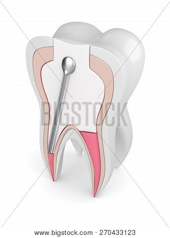 3D Render Of Tooth With Stainless Steel Dental Post And Filling