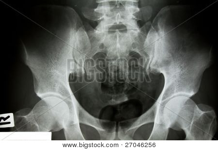 X-Ray van het bekken en de wervelkolom.
