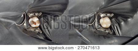 Human Teeth Close-up During Restoration Of Filling. The Concept Of Aesthetic Dentistry