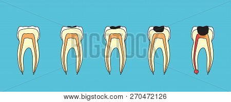 The Destruction Of The Tooth And As A Result Pulpitis. Phased Illustration.