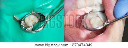Human Teeth Close-up During Restoration Of Filling. The Concept Of Aesthetic Dentistry