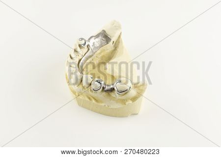 Steel Base Of The Clasp Prosthesis On The Gypsum Model