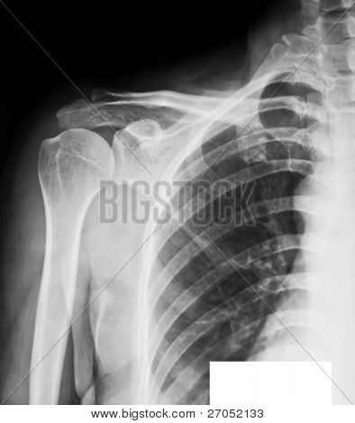 X-ray lidské rameno
