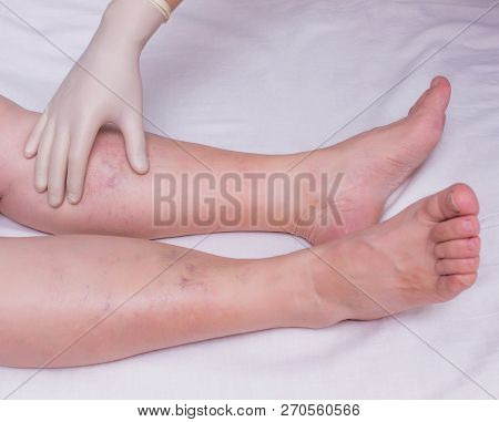 Doctor Examines The Patients Legs For The Presence And Degree Of Varicose Veins In The Legs, Close-u