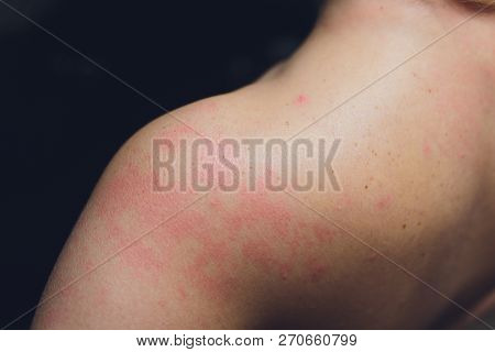 Close Up Allergy Rash, Around Back View Of Human With Dermatitis Problem Of Rash , Allergy Rash And 