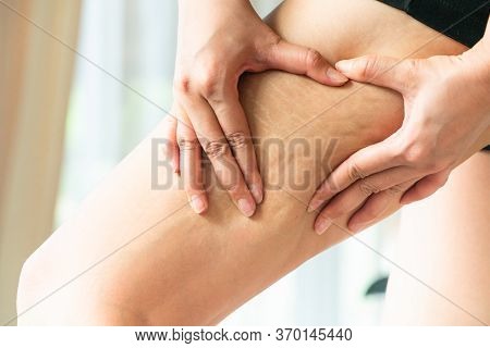 Female Hand Holds Fat Cellulite And Stretch Mark On Leg At Home, Women Diet Style Concept