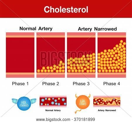 Cholesterol In Artery, Health Risk , Vector Design