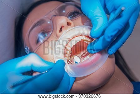 Dental Treatment With Expander. Modern Medical Technology