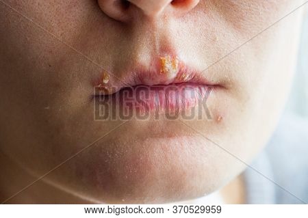 Herpes Disease On The Lips Of A Young Girl. Wounds From Herpes On The Lips Of A Person. Herpes Foci.