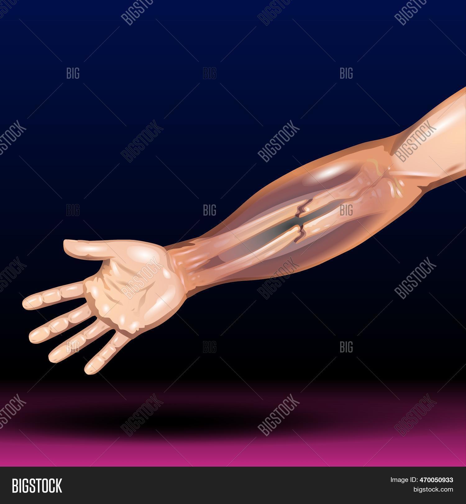 Hand Bone Fracture Image & Photo (Free Trial) Bigstock
