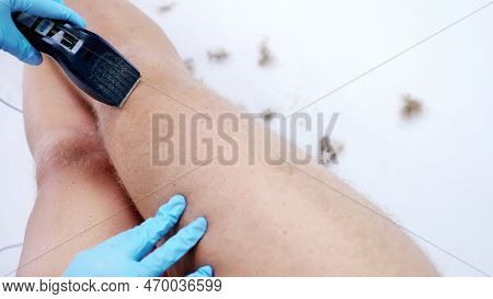 Close-up, Cosmetologist Female Hands In Gloves Haircut Body Hair Of A Naked Hairy Man, His Legs, Who