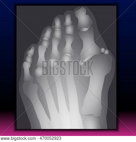 X-ray Of Foot - Navicular Bone, Metatarsal Bone, Phalanges