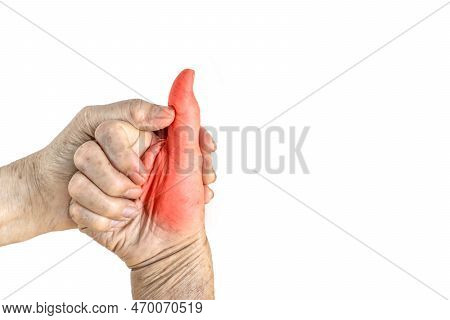 Painful Thumb And Thenar Muscle Of The Elderly Man. Isolated On White.