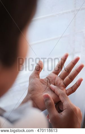 Close Up Of Dry Cracked Skin Of A Mens Hand