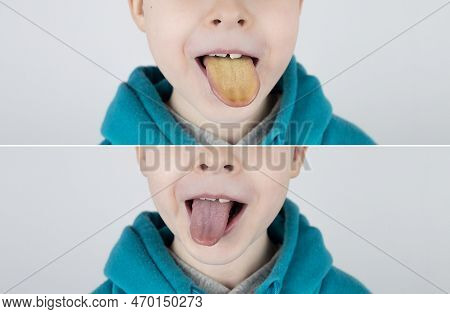 Blond Boy Has A Yellow Tongue. Painful Yellow Coating On The Mucous Membrane Of The Tongue. Diseases