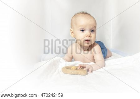 A Baby With A Hemangioma On His Neck Lies On A White Background. A Five-month-old Girl In A Reusable
