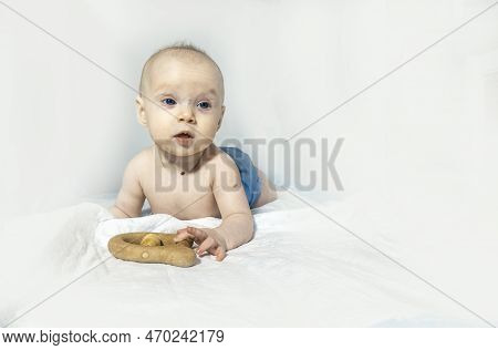 A Baby With A Hemangioma On His Neck Lies On A White Background. Banner With A Copy Space. Face Of A