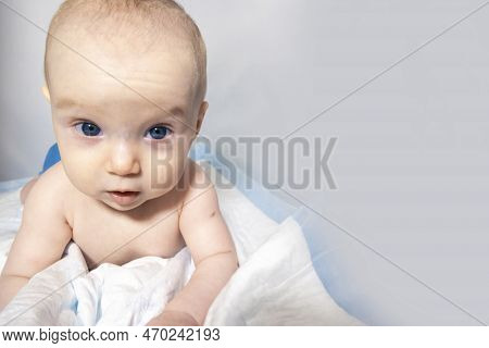 A Baby With A Hemangioma On His Neck Lies On A White Background. Banner With A Copy Space. Face Of A