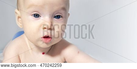 A Baby With A Hemangioma On His Neck Lies On A White Background. Banner With A Copy Space. Profile O