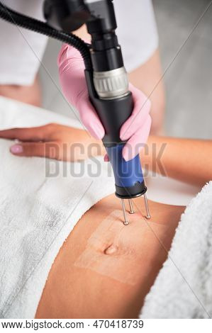Close Up Cosmetologist Hand In Sterile Gloves Using Erbium Ablative Laser Machine While Performing L