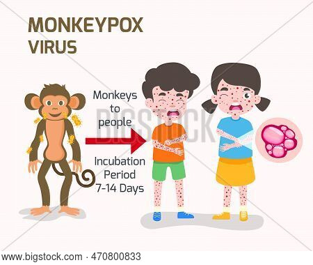 Monkeypox Virus Elements, Human Body With Rash. Symptoms Of The Disease, Swollen Lymph Nodes, Vector