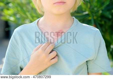Mark On The Skin Of Chest Of Eight Years Old Child. Hemangioma Is A Red Birthmark From Blood Vessels