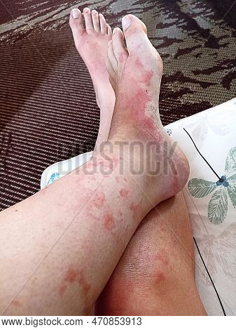 Caucasian Woman With Leg And Foot Allergy