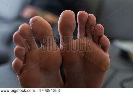 A Mans Toes Showing What Looks Like A Rash With Red Blotchy Skin. A Common Side Effect Of Covid-19 O