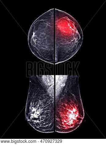 X-ray Digital Mammogram Or Mammography Of Both Side Breast Cc View And Mlo  .