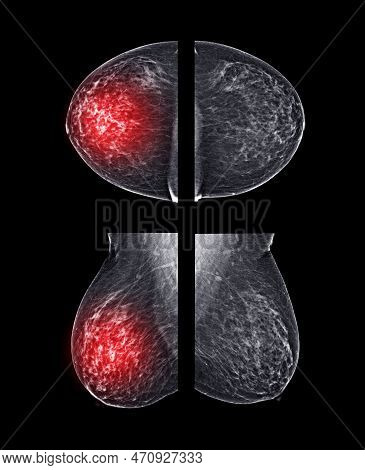 X-ray Digital Mammogram Or Mammography Of Both Side Breast Cc View And Mlo  .