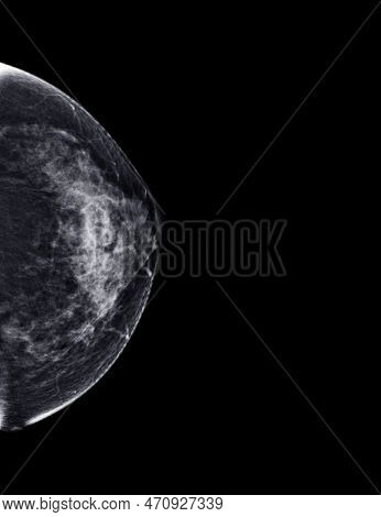 X-ray Digital Mammogram Or Mammography Of Both Side Breast Standard Views Are Bilateral Craniocaudal