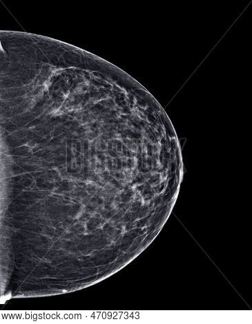 X-ray Digital Mammogram Or Mammography Of Both Side Breast Standard Views Are Bilateral Craniocaudal
