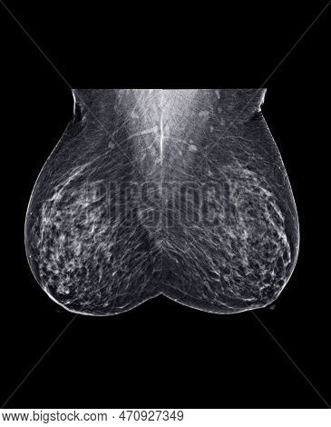 X-ray Digital Mammogram Or Mammography Of Both Side Breast Standard Views Are  Mediolateral Oblique