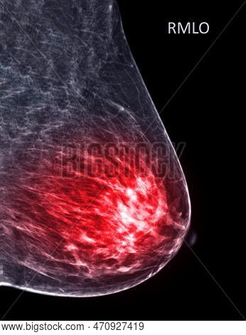 X-ray Digital Mammogram Or Mammography Of Both Side Breast Standard Views Are  Mediolateral Oblique