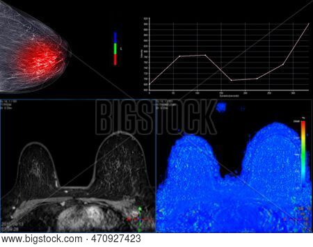 Magnetic Resonance Spectroscopy Of The Breast.