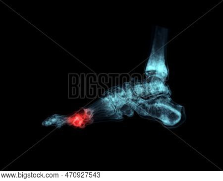 3D Rendering  Of The Foot Bones For Diagnosis Bone Fracture And Rheumatoid Arthritis.