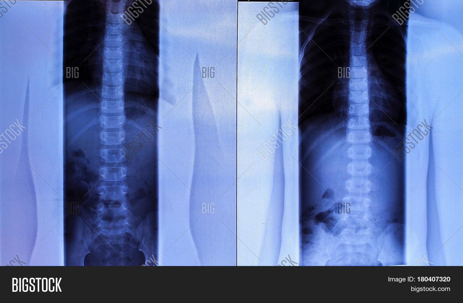 рентген пояснично-крестцового отдела. люмбализация s1 рентген. рентген грудного отдела позвоночника. грудопоясничный отдел позвоночника рентген. болезнь бехтерева рентген шейный отдел.