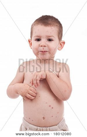 小さな少年の聖霊降臨祭の天然痘