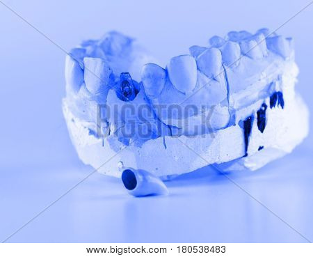 metal-ceramic dental crown is tried on an artificial model