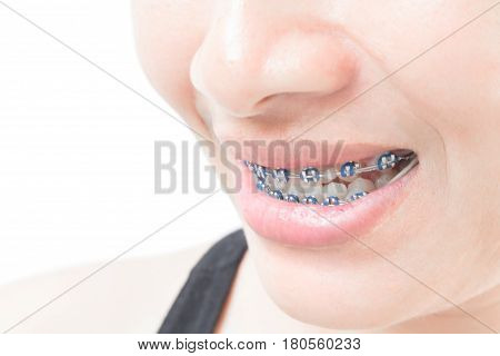 Close up woman smiling with Ceramic and Metal Braces on white background beauty and healthy concept
