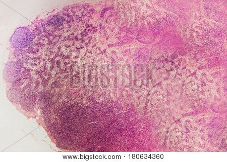 Science background. Enlargement and inflammation of the lymph nodes dog (lymphadenopathy or lymphadenitis). Educational material for the study and treatment of animals. Biological microscope prepared slides. Colouring with hematoxylin and eosin.