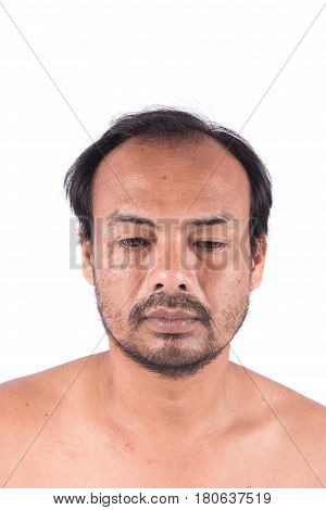 Stitch Scars on the Face and bald head of young man