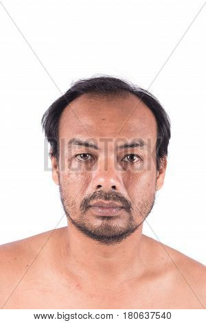 Stitch Scars on the Face and bald head of young man