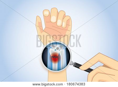 Magnifier on hand magnifying inner arm for looking wrist fracture. Illustration about medical concept.