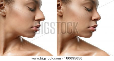 Young African-American woman before and after rhinoplasty on white background. Plastic surgery concept