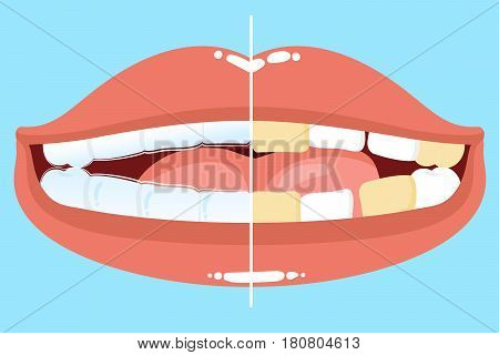 cute cartoon mouth with tooth wear invisible braces before and after