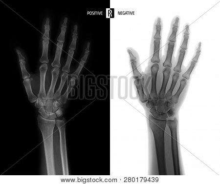 X-ray Of The Wrist Joint. Normal. Negative.