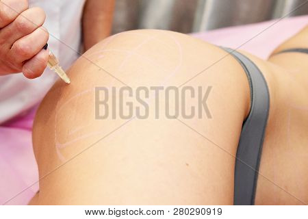 Beauty Injections In The Salon. The Procedure For Skin Tightening And Rejuvenation.