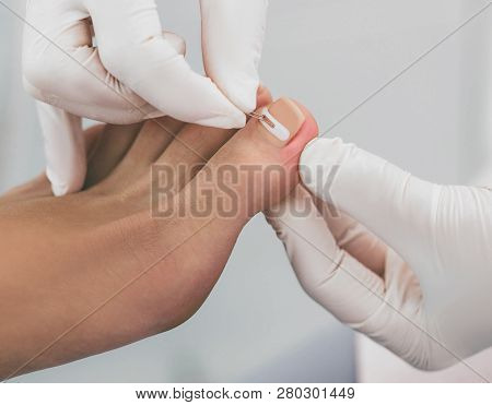 Doctor Podiatry Treats Ingrown Nail. Onychocryptosis, Nail Disease